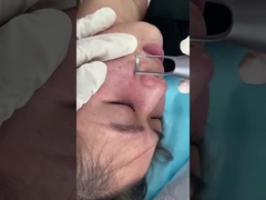 皮の色素形成の損害問題の処置のための1064nm 532nmの大広間ピコ秒 レーザー機械