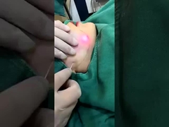 プロ 1470nm ダイオードレーザー 脂肪削減マシン 2-3 セッションで目に見える結果